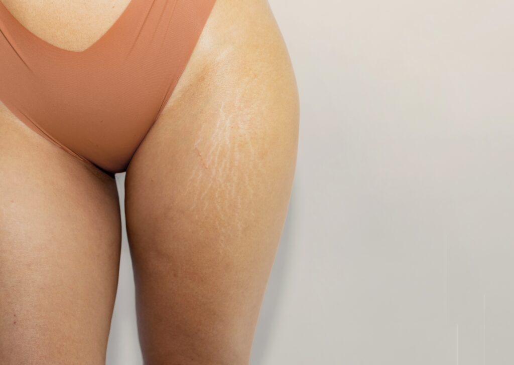 Peut-on se débarrasser de la cellulite sans chirurgie ?